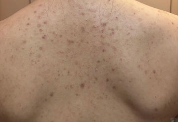 The Back Acne Bottleneck: Eliminating Post-Workout Body Blemishes