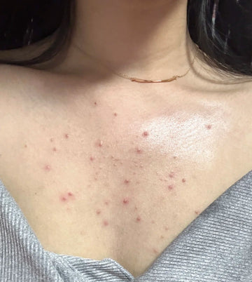 The Invisible Congestion: Addressing Back and Chest Bumps Chemically