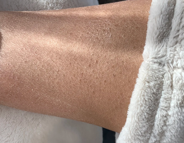 The Dry Plaque Dynamic: Reconditioning Scaling Skin Stacks via 60% Urea