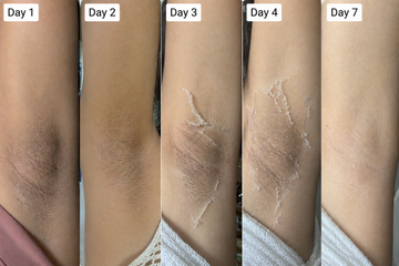 The Friction Shadow: Clearing Localized Hyper-Keratinization and Dullness