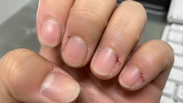 The Digital Hardness: Restoring Chapped Hands and Splitting Cuticles