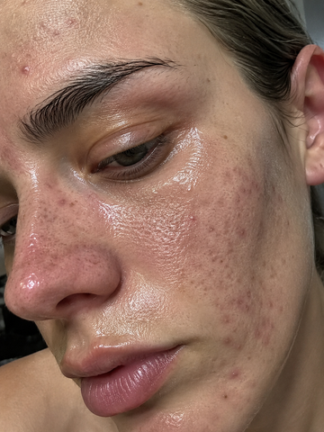 The Dull Congestion Reset: Reversing Sebum Seepage and Glycation Shadows