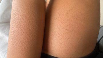 The Follicular Plug: Resolving Arm and Thigh Bumps Chemically