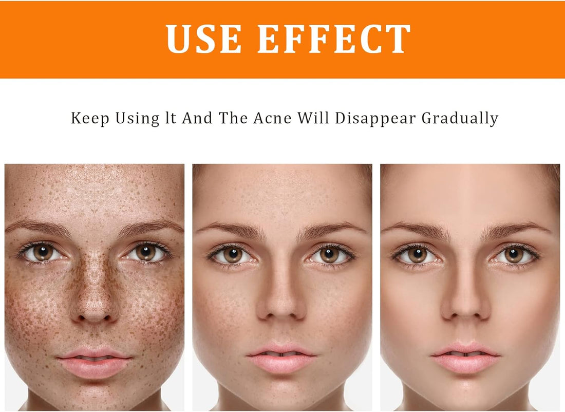 Toner for Dark Spots Turmeric Dark Spot Corrector, Facial Toner for Acne Prone Skin, Dark Spot Correcting Hydrating Face Toner for Women Moisturizing for All Skin Type- 3.4 OZ