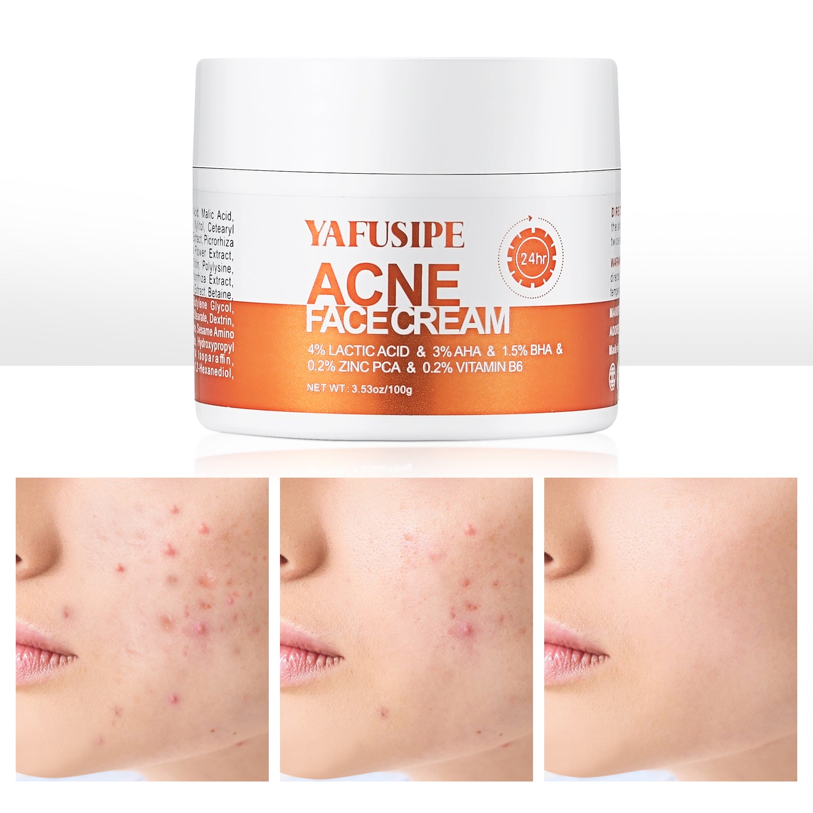 YAFUSIPE Rapid Clearing Acne Cream - Gentle Blemish Spot Care for Face , Sensitive Skin Friendly (30g/1oz)