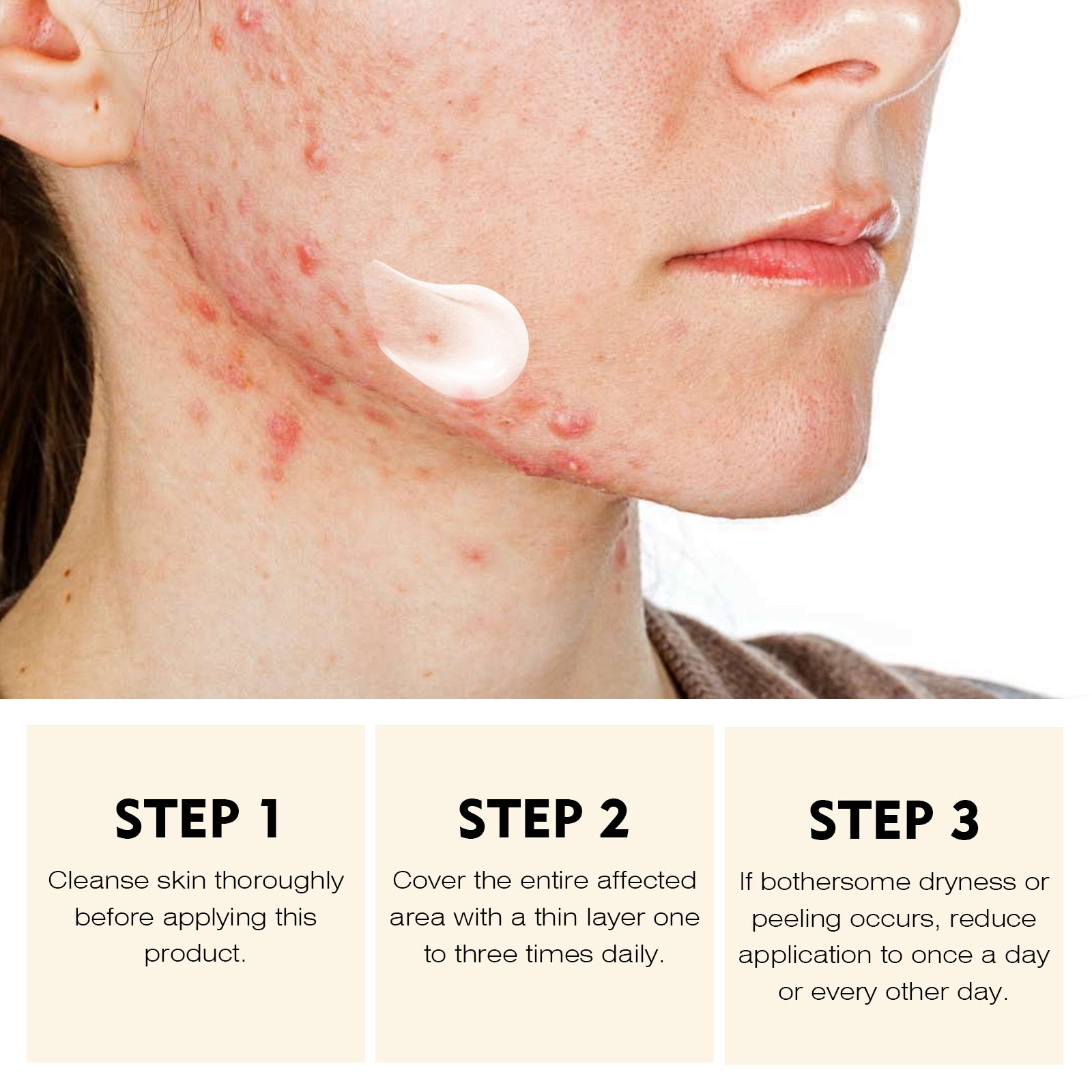 YAFUSIPE Rapid Clearing Acne Cream - Gentle Blemish Spot Care for Face , Sensitive Skin Friendly (30g/1oz)