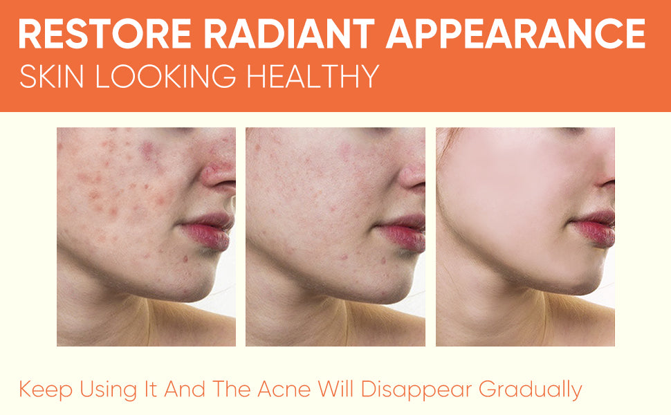 YAFUSIPE Rapid Clearing Acne Cream - Gentle Blemish Spot Care for Face , Sensitive Skin Friendly (30g/1oz)