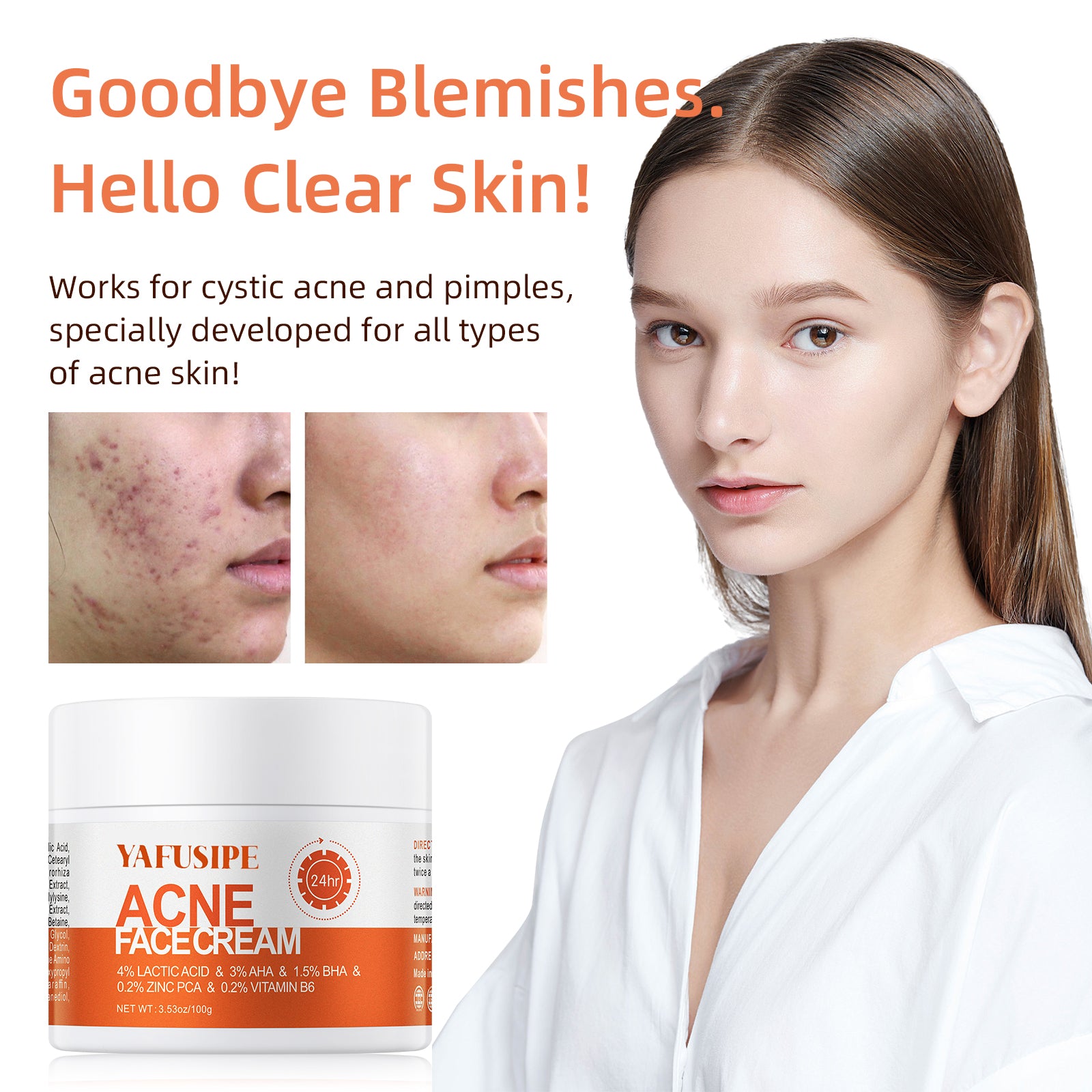 YAFUSIPE Rapid Clearing Acne Cream - Gentle Blemish Spot Care for Face , Sensitive Skin Friendly (30g/1oz)