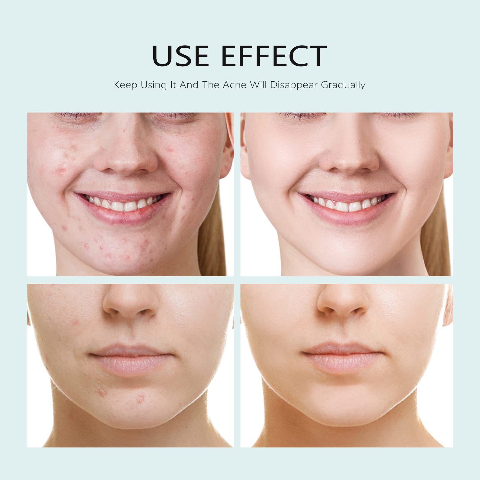 Acne Sheet Mask With Salicylic Acid Azelaic Acid